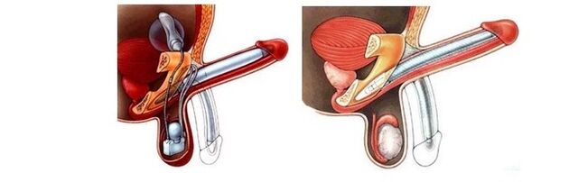 prostheses for penis enlargement