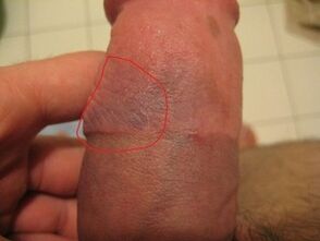 hematoma of the penis due to improper use of the pump